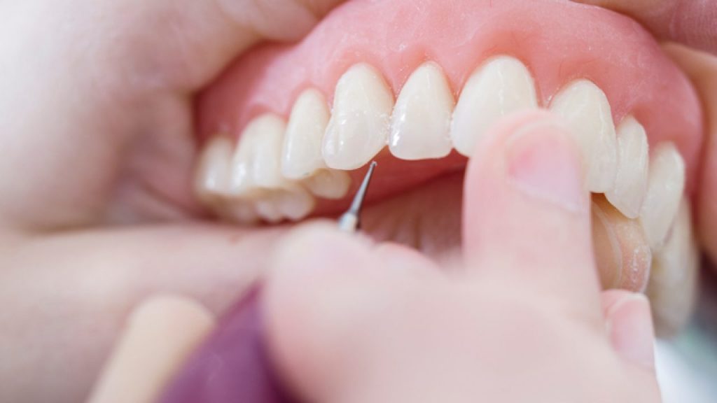 Tooth restoration: Basics about prosthodontics explained!