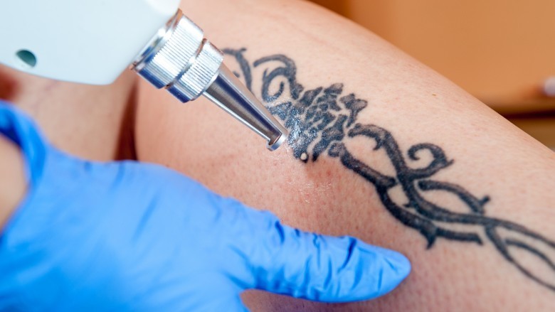 All you need to know about Tattoo Removal