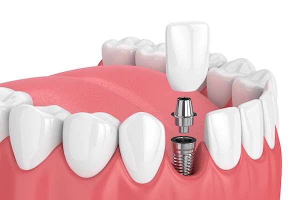 Why You Should Get Dental Implants?