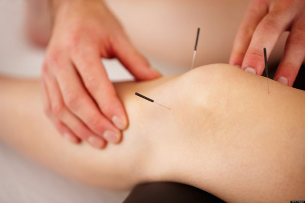 Dry Needling in Singapore