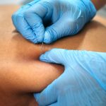 Dry-Needling-in-Singapore