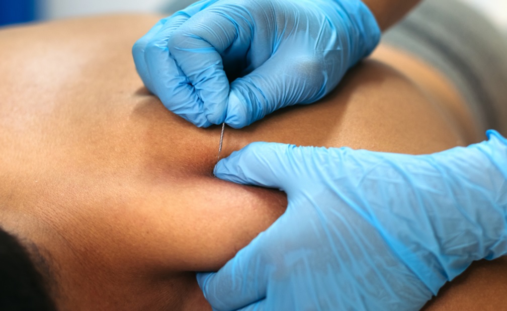 Everything You Need to Know About Dry Needling in Singapore