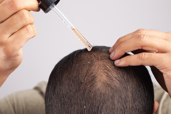 Hair Loss Treatments