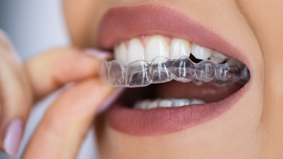 Secrets to a Radiant Smile: Unveiling the Power of Invisalign